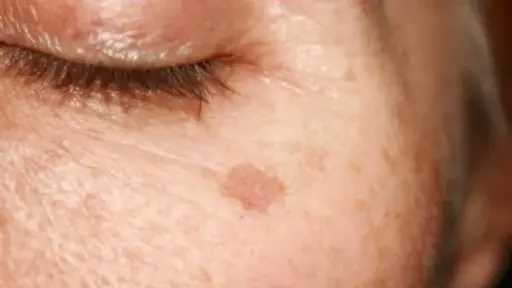 بقع التقدم في العمر.. أسباب ظهورها وطرق الوقاية منها