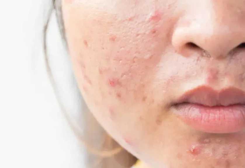 حلول طبيعية فعّالة للتخلص من ندبات حب الشباب نهائياً