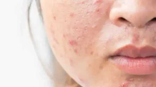 حلول طبيعية فعّالة للتخلص من ندبات حب الشباب نهائياً حلول طبيعية فعّالة للتخلص من ندبات حب الشباب نهائياً