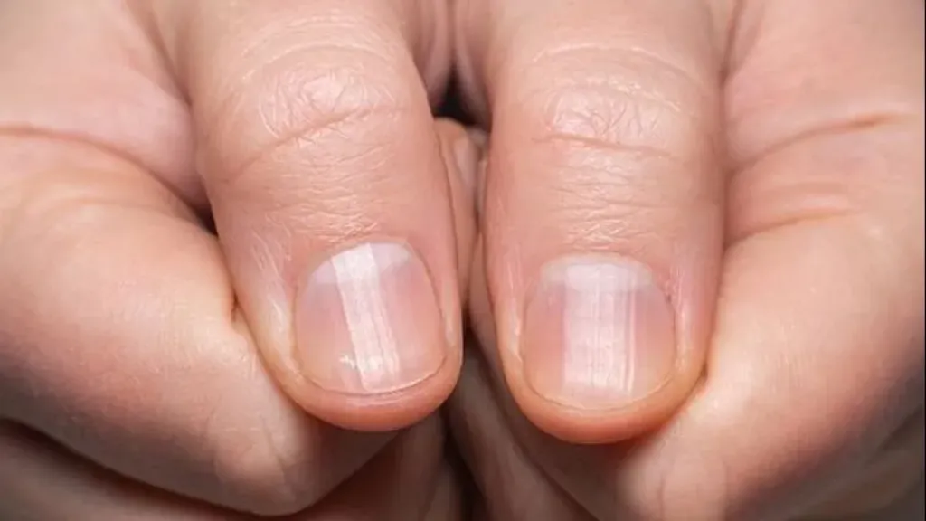 اصفرار الأظافر