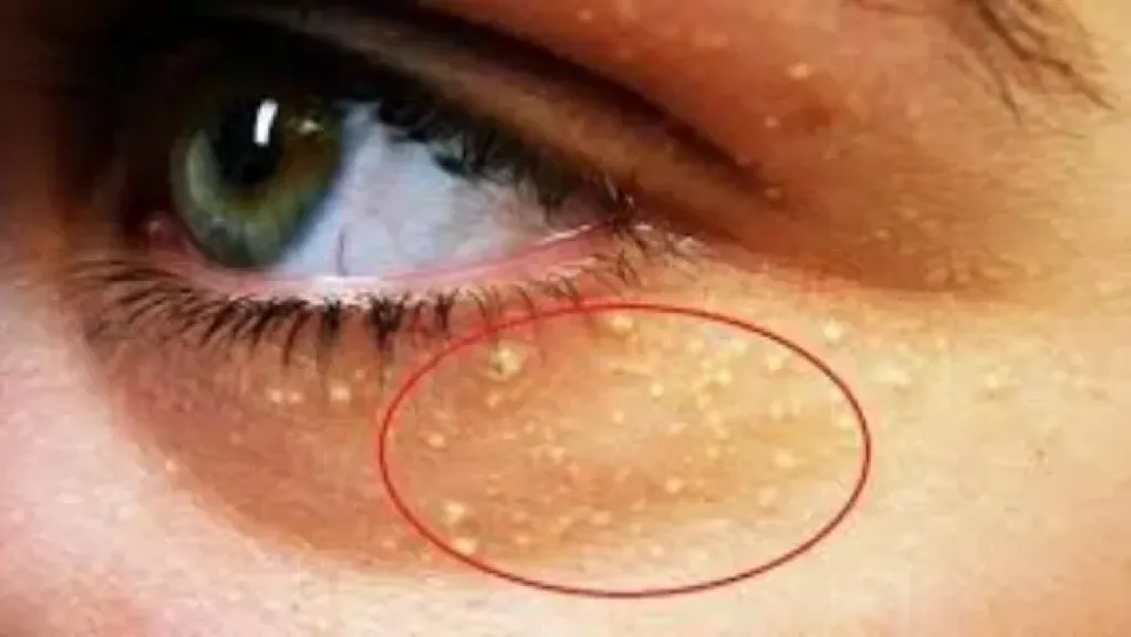 ارتفاع الكوليسترول