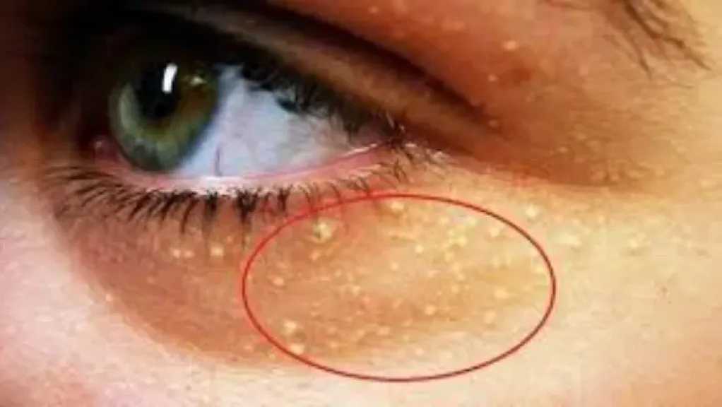 مؤشرات وجهك قد تخبرك عن ارتفاع الكوليسترول.. علامات خفية يجب الانتباه إليها