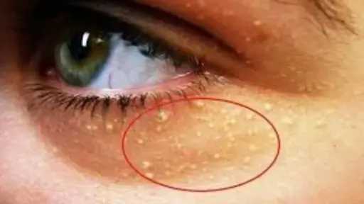 مؤشرات وجهك قد تخبرك عن ارتفاع الكوليسترول.. علامات خفية يجب الانتباه إليها