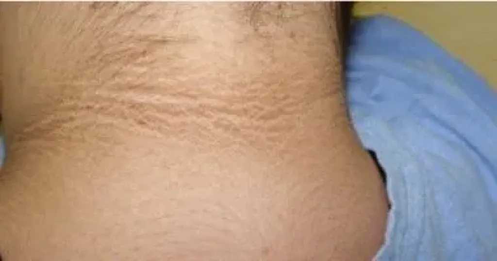 علامات على الجلد قد تكشف مشكلات صحية خطيرة.. تعرف على مرض ”الشواك الأسود” وأسبابه