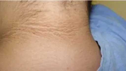 علامات على الجلد قد تكشف مشكلات صحية خطيرة.. تعرف على مرض ”الشواك الأسود” وأسبابه