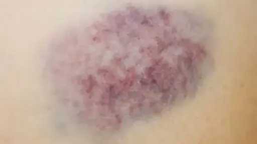 هل الكدمات المفاجئة ناقوس خطر أم مجرد أمر عابر؟ إليك التفاصيل