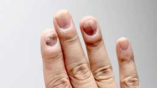 الأظافر.. مؤشرات دقيقة لصحة جسمك قد تنقذك من أمراض خطيرة
