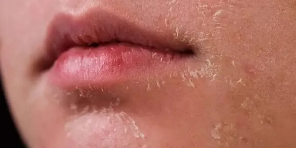 البشرة الجافة