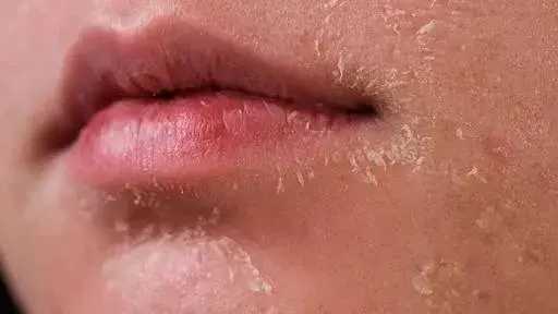 كيف تتعامل مع البشرة الجافة؟ أسبابها، أعراضها، وعلاجاتها بالتفصيل