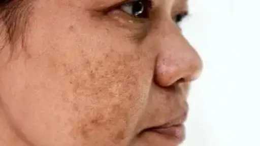 فرط التصبغ.. دليل شامل لفهم الأسباب وخطوات العلاج من الداخل