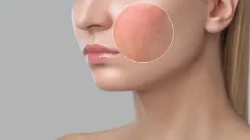 حلول طبيعية لمشكلة المسام الواسعة.. خطوات فعالة لبشرة متألقة