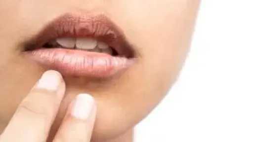 التهاب الجلد حول الفم.. الأسباب، الأعراض، والعلاج الأمثل للتعافي والوقاية التهاب الجلد حول الفم.. الأسباب، الأعراض، والعلاج الأمثل للتعافي والوقاية