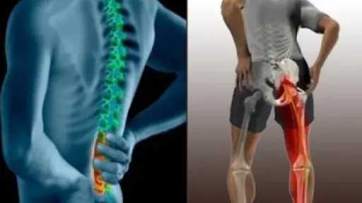 عرق النسا.. ألم الظهر الذي يمتد للأطراف وأسبابه وطرق الوقاية منه