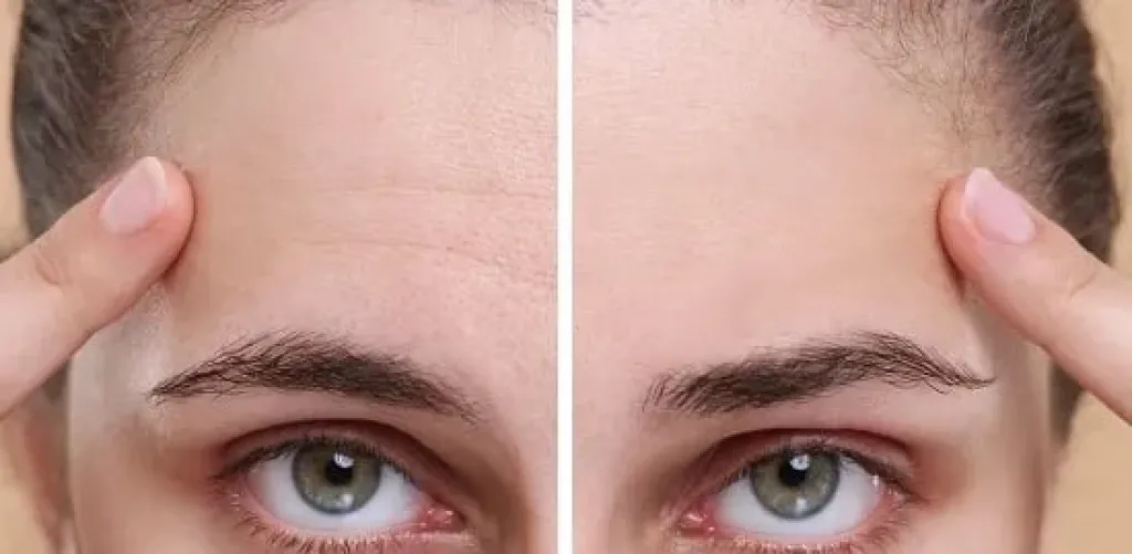 تجاعيد الجبهة