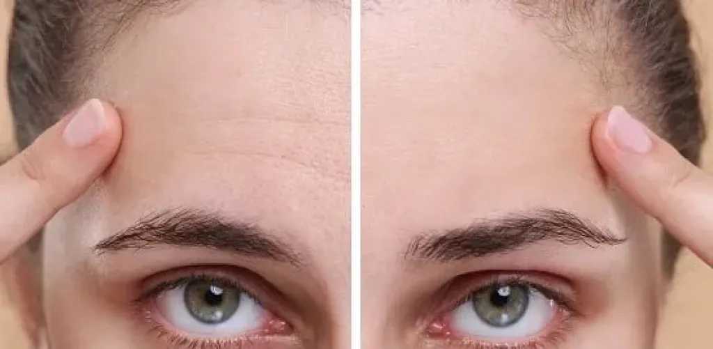 كيفية التخلص من تجاعيد الجبهة بطرق طبيعية فعّالة