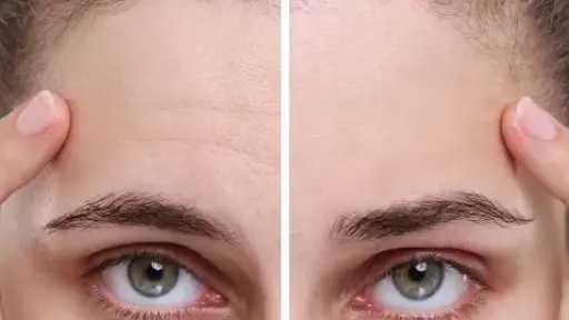 كيفية التخلص من تجاعيد الجبهة بطرق طبيعية فعّالة كيفية التخلص من تجاعيد الجبهة بطرق طبيعية فعّالة