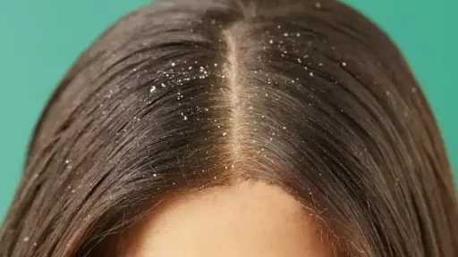 القضاء على قشرة الشعر.. حلول فعالة للحفاظ على صحة فروة الرأس والشعر القضاء على قشرة الشعر.. حلول فعالة للحفاظ على صحة فروة الرأس والشعر