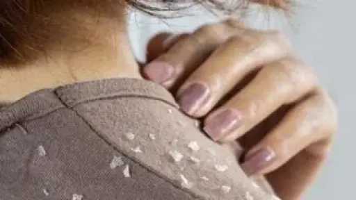 القشرة.. أكثر من مشكلة جمالية وأحيانًا إشارة لاضطراب صحي