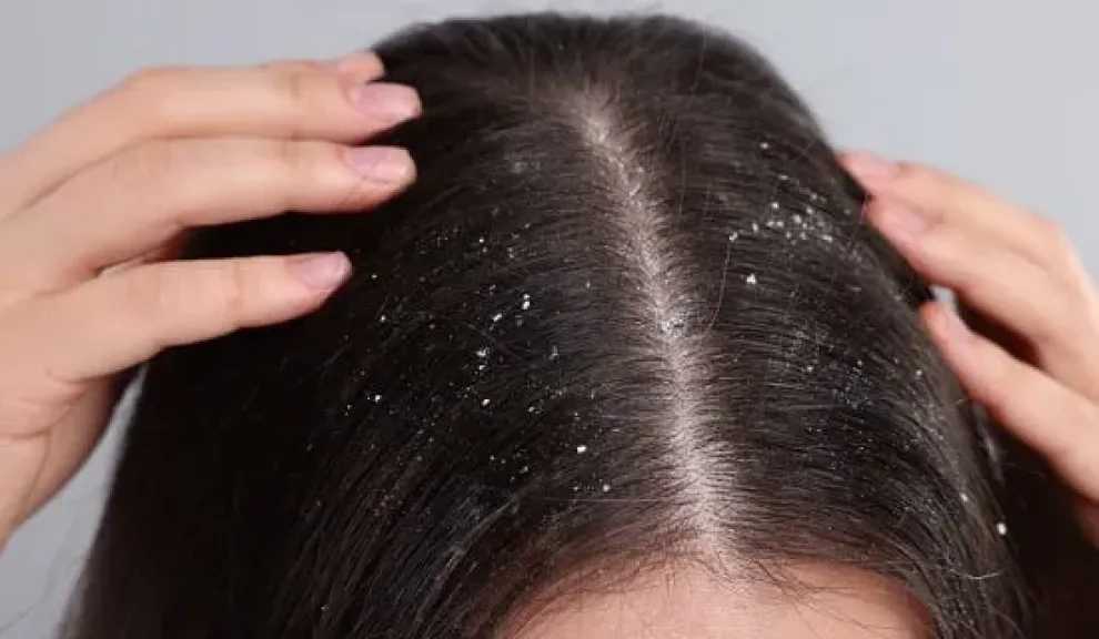 طرق طبيعية للتخلص من قشرة الرأس.. الأسباب والعلاجات