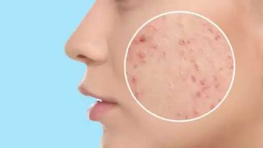 تحذير للنساء.. ظهور بثور غير معتادة قد يكشف عن مشكلات صحية خطيرة تحذير للنساء.. ظهور بثور غير معتادة قد يكشف عن مشكلات صحية خطيرة