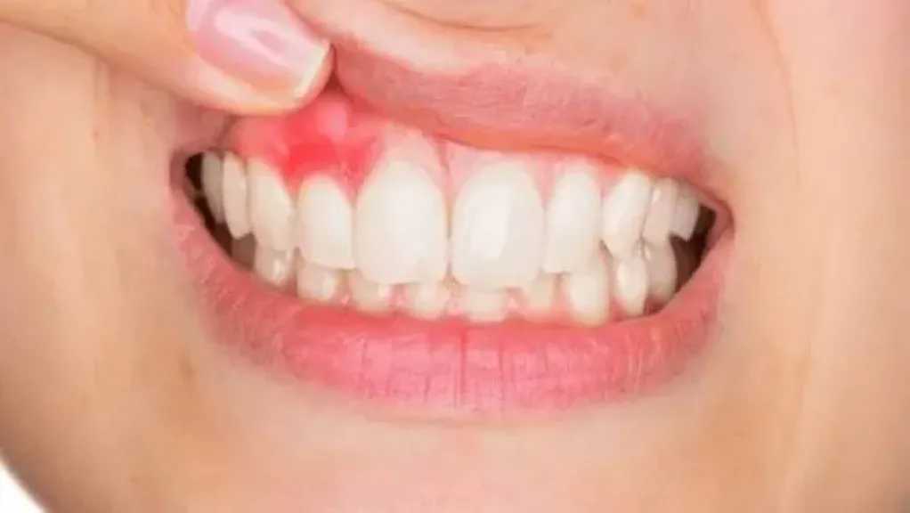 التهاب اللثة عند النساء.. الأعراض، الأسباب وطرق العلاج الفعّالة