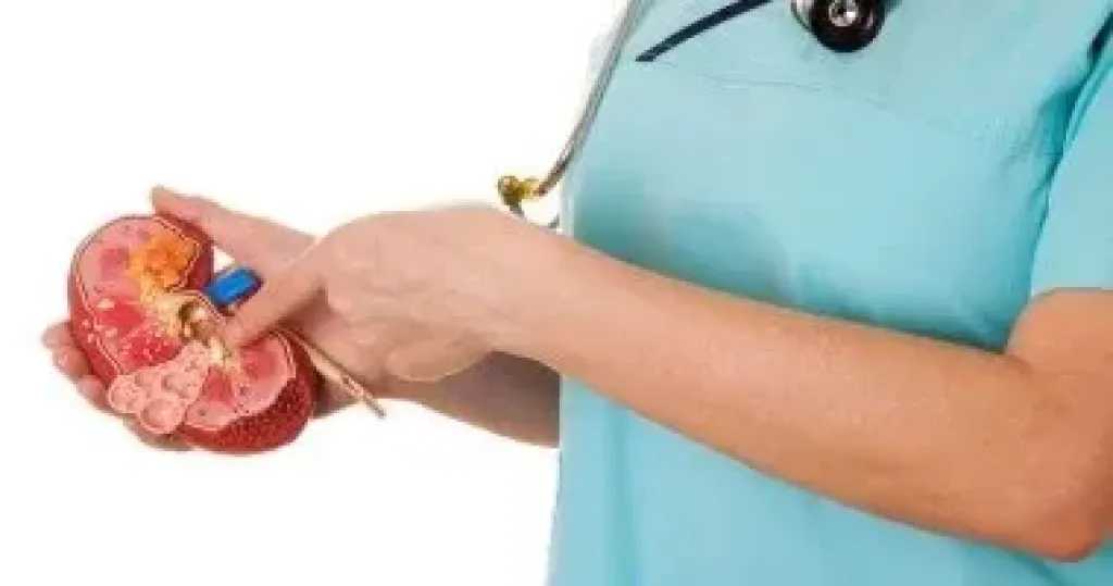 لماذا تزداد حصوات الكلى بين الرجال؟.. خبراء يوضحون الأسباب وطرق الوقاية
