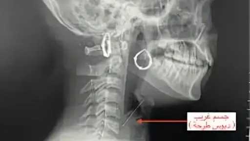 استخراج «دبوس طرحة» من حنجرة فتاة في بنها