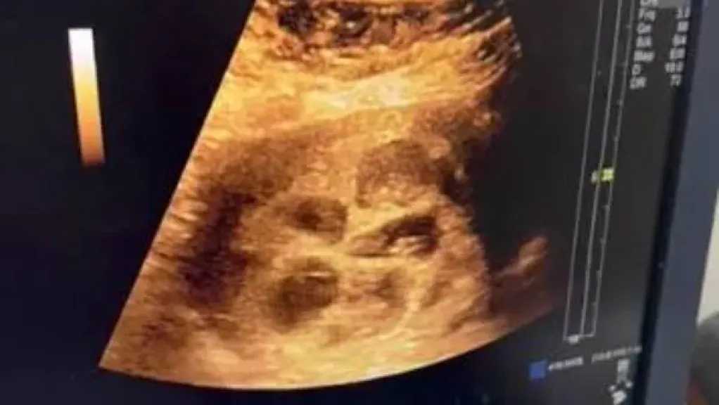 حالة طبية نادرة.. سيدة مصرية تضع 8 توائم بعد تأخر الإنجاب