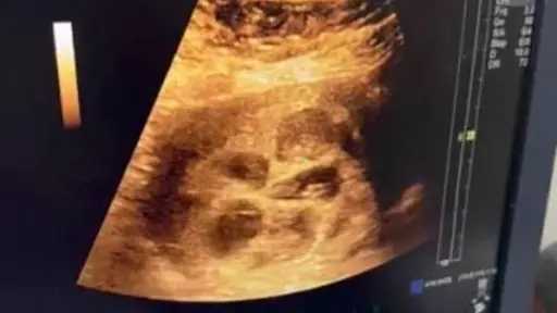 حالة طبية نادرة.. سيدة مصرية تضع 8 توائم بعد تأخر الإنجاب