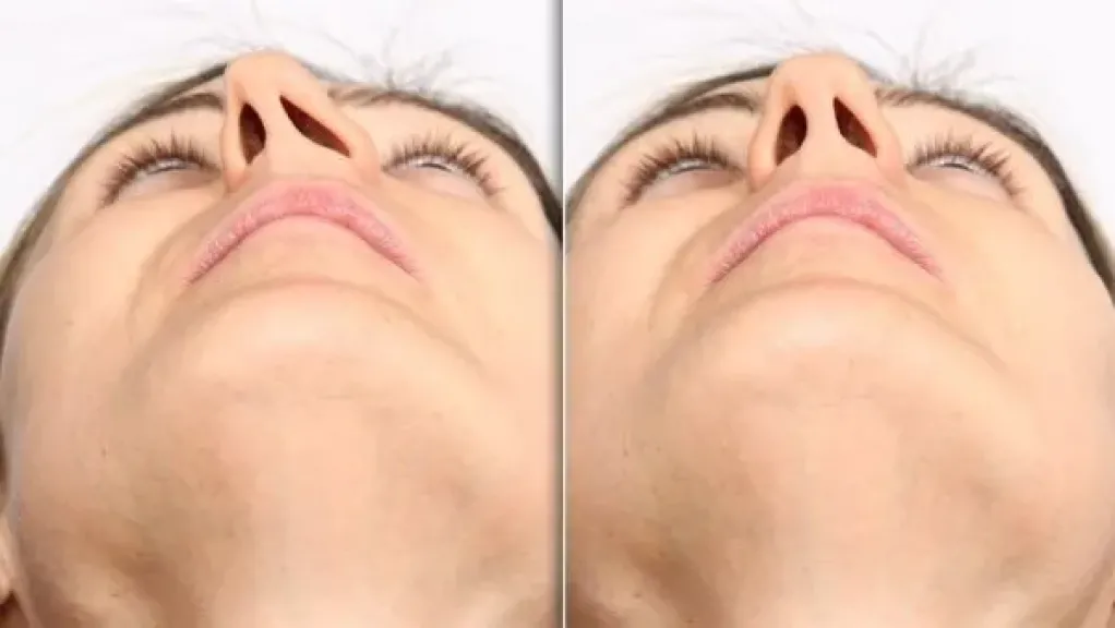 انسداد الأنف