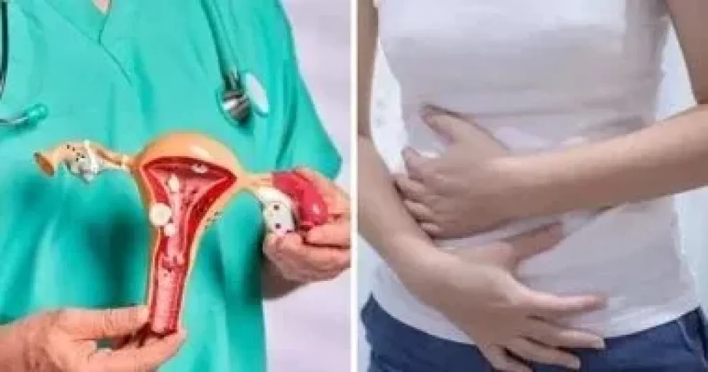 بطانة الرحم المهاجرة