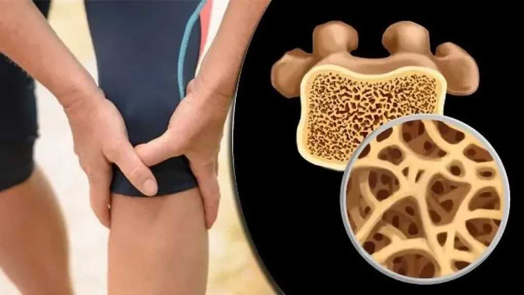 هرمونات الجسم وتأثيرها الخفي.. ثلاثة أسباب ترتبط بهشاشة العظام