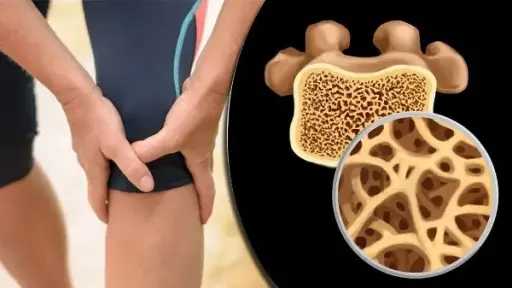 هرمونات الجسم وتأثيرها الخفي.. ثلاثة أسباب ترتبط بهشاشة العظام