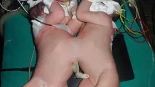 دار الإفتاء تحدد ضوابط فصل التوأم الملتصق وفق الشريعة الإسلامية