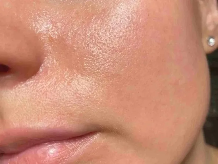 المسام الواسعة