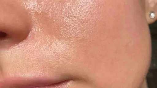 وصفات طبيعية للتخلص من مشكلة المسام الواسعة