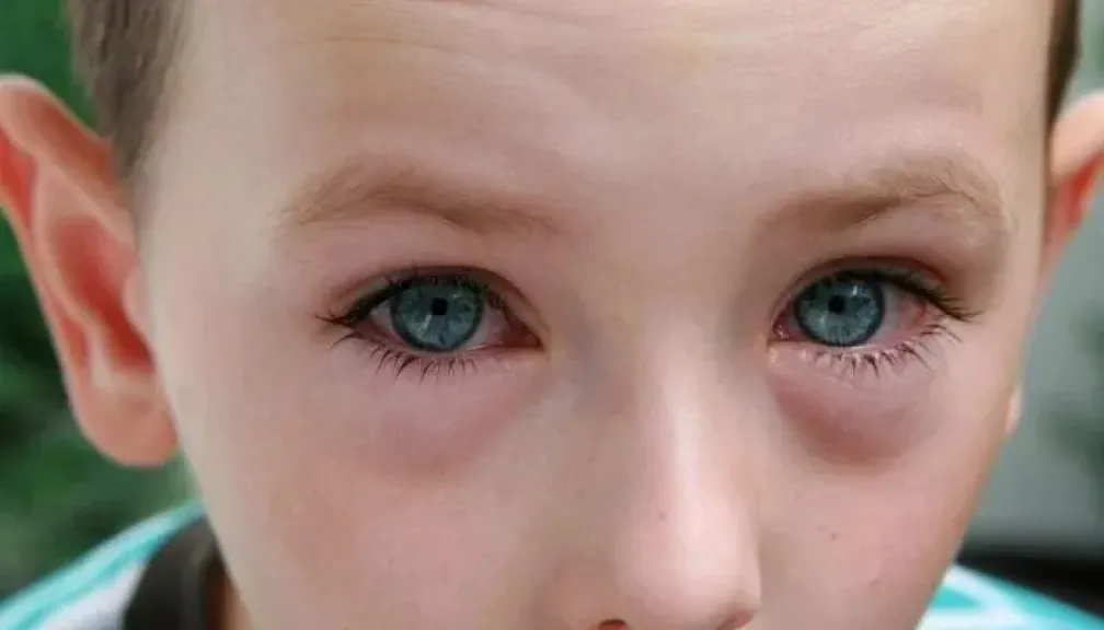 الرمد الربيعي