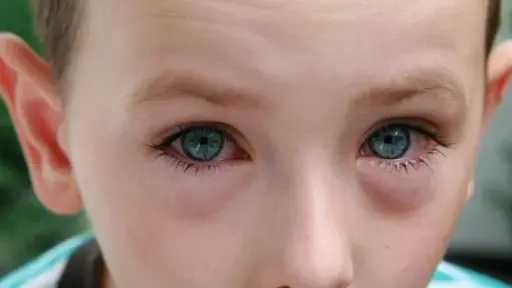 الصحة تحذر الأمهات: انتشار الرمد الربيعي بين الأطفال مع تغيرات الطقس وضرورة الوقاية المبكرة