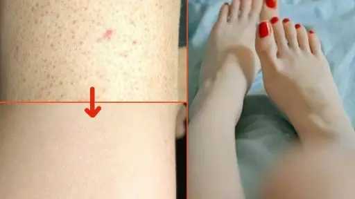 ”جلد الوزة”.. حالة جلدية شائعة يمكن علاجها بالعناية اليومية