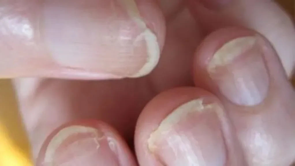 تقصف الأظافر