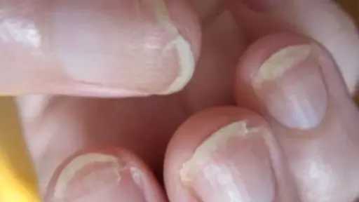 أسباب تقصف الأظافر.. مشكلات صحية شائعة لدى النساء وتفاصيل تأثيراتها المختلفة
