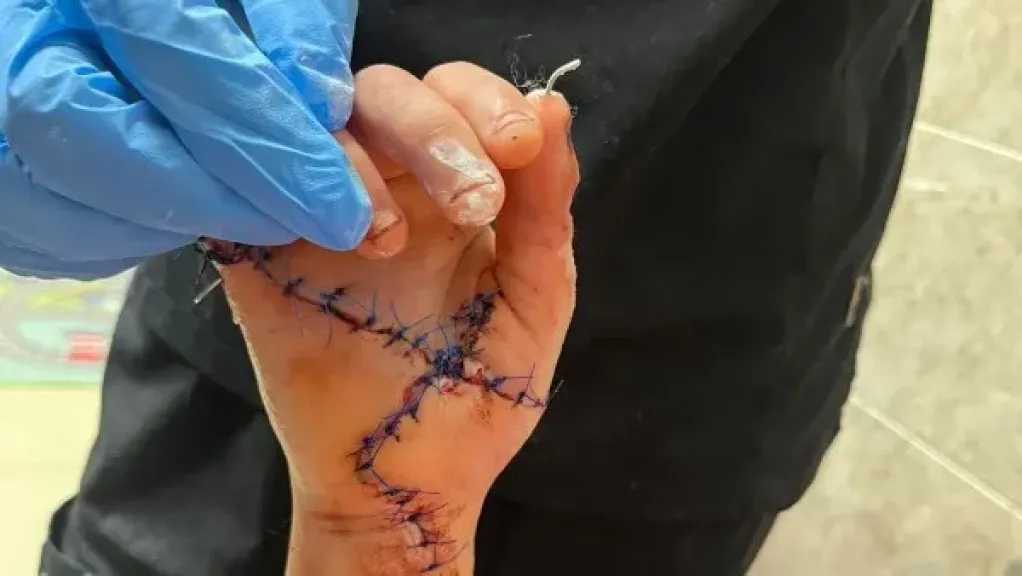إنقاذ فتاة تعرضت لبتر شبه كامل باليد اليمنى بعد اعتداء بالساطور في سوهاج