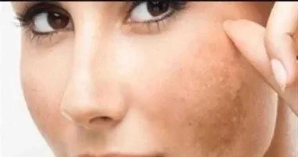اضطراب الهرمونات يظهر على البشرة والأظافر: مؤشرات خفية لأمراض أكبر