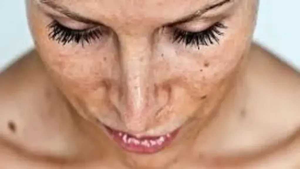 كيفية حماية البشرة من أضرار أشعة الشمس خلال عطلة العيد