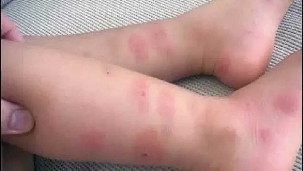 تزايد حساسيات الحشرات لدى الأطفال في الصيف: كيف نحميهم ونعالجهم؟