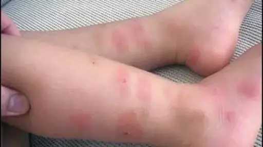 تزايد حساسيات الحشرات لدى الأطفال في الصيف: كيف نحميهم ونعالجهم؟