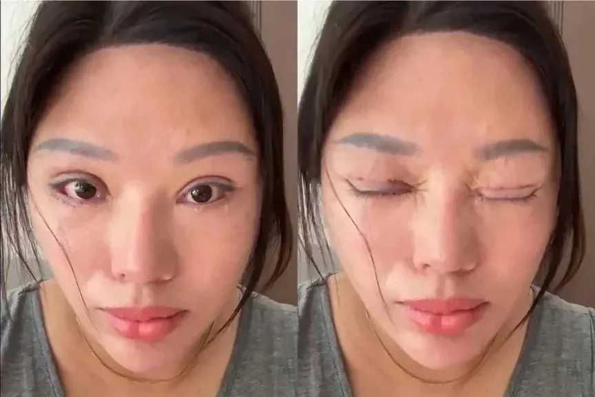 فشل عملية تجميل يحول حياة امرأة صينية إلى كابوس صحي