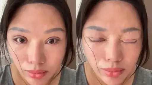 فشل عملية تجميل يحول حياة امرأة صينية إلى كابوس صحي فشل عملية تجميل يحول حياة امرأة صينية إلى كابوس صحي