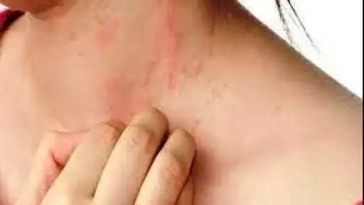 ارتفاع حالات الإصابة بحمو النيل مع بداية الصيف.. الأسباب والعلاج