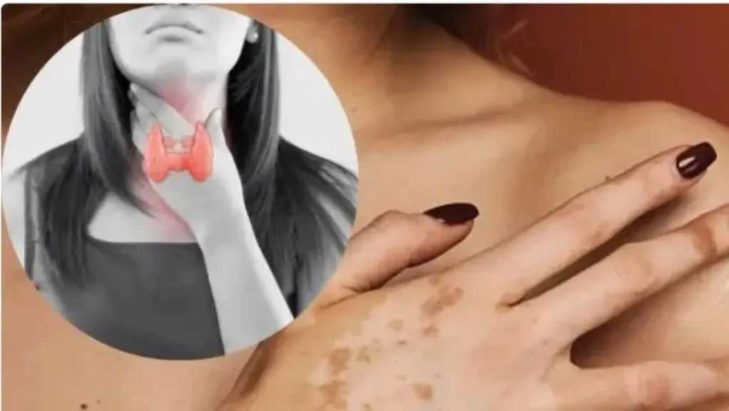 اليوم العالمي للبهاق.. كشف العلاقة بين المرض واضطرابات الغدة الدرقية